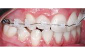 Brackets Aqua Roth .022 Kit 5-5 Sup. e Inf.